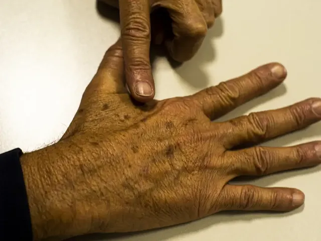 https://timnews.com.br/system/images/photos/16773651/original/_melanoma_cutaneo_abr_200522_1?1784632482